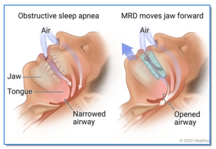 Medical illustration showing how a mandibular repositioning device opens the airway in obstructive sleep apnea