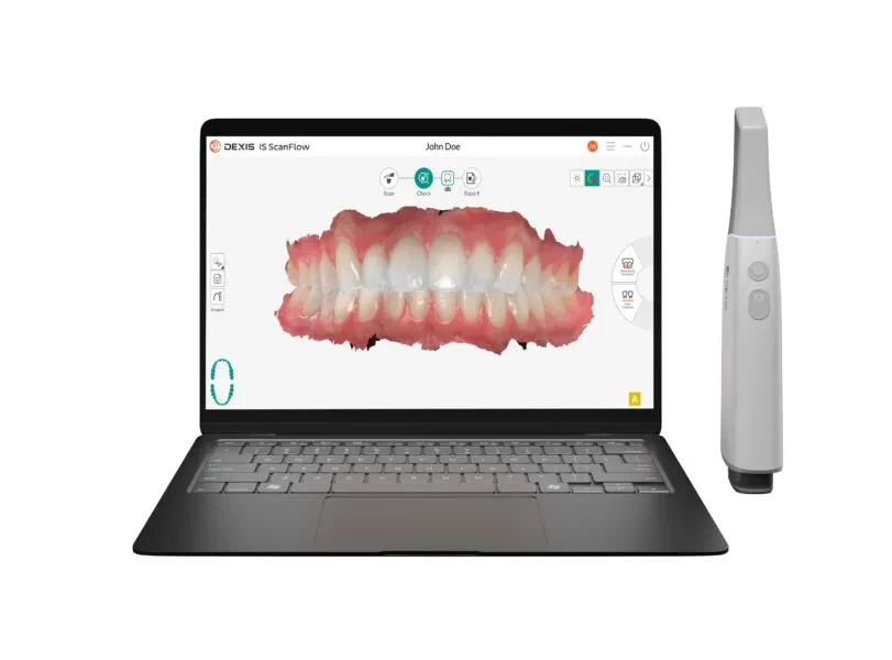 Dexis Imprevo intraoral scanner with laptop showing 3D dental scan