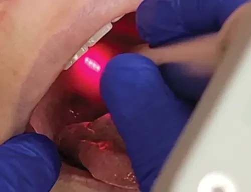 QuietNite fractional laser being applied inside patient's mouth