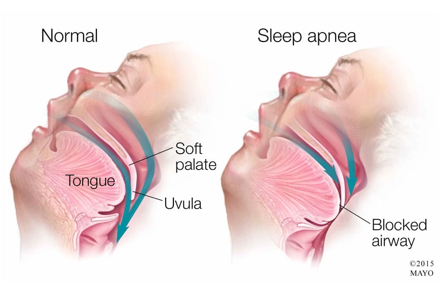 Anatomy diagram showing obstructive sleep apnea — airway collapse during sleep
